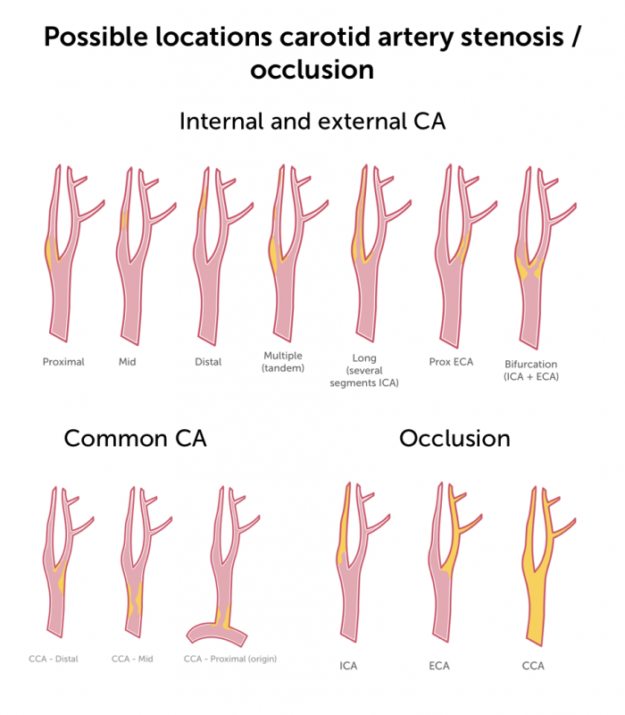 11 Carotid Artery Stenosis Part 1 B Mode And Color Flow 123 Sonography